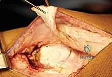 Illustration of osteotomy for crouch - Dr. Mohammed Hutaif