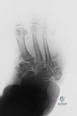 التعافي والعودة للمشي بأحذية مخصصة