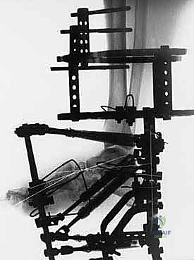 التشخيص الدقيق لمراحل قدم شاركو