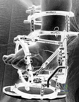 تطبيق تقنية التثبيت الخارجي الدائري