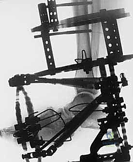 نتائج ما بعد إزالة جهاز التثبيت الخارجي