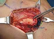 Medial Collateral Ligament Repair & Reconstruction: An Intraoperative Masterclass