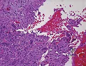 أكياس العظام الحميدة: دليل شامل للتشخيص والعلاج الجراحي مع الأستاذ الدكتور محمد هطيف في صنعاء