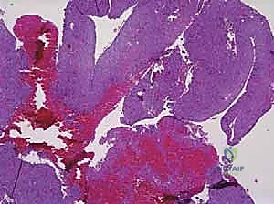 صورة مجهرية مكبرة تظهر مساحات مملوءة بالدم في كيس العظم المتمدد