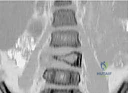 صورة أشعة سينية تظهر كيس عظم متمدد