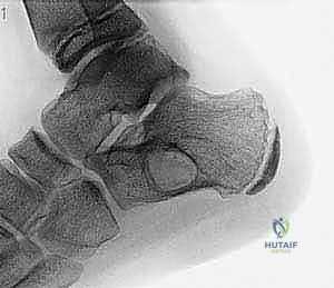 صورة شعاعية توضح كيس عظم أحادي الغرفة في عظم العضد