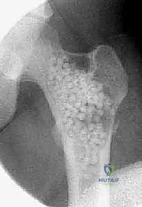 صورة توضيحية لـ أكياس العظام الحميدة: دليل شامل للتشخيص والعلاج الجراحي مع الأستاذ الدكتور محمد هطيف في صنعاء