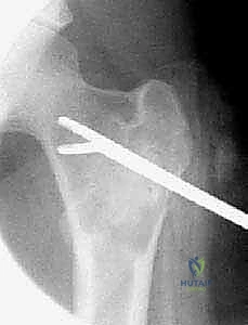 صورة توضيحية لـ أكياس العظام الحميدة: دليل شامل للتشخيص والعلاج الجراحي مع الأستاذ الدكتور محمد هطيف في صنعاء