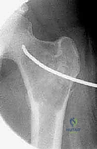 صورة توضيحية لـ أكياس العظام الحميدة: دليل شامل للتشخيص والعلاج الجراحي مع الأستاذ الدكتور محمد هطيف في صنعاء