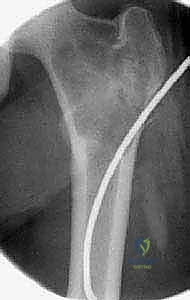 صورة توضيحية لـ أكياس العظام الحميدة: دليل شامل للتشخيص والعلاج الجراحي مع الأستاذ الدكتور محمد هطيف في صنعاء