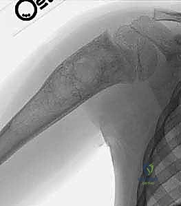 صورة توضيحية لـ أكياس العظام الحميدة: دليل شامل للتشخيص والعلاج الجراحي مع الأستاذ الدكتور محمد هطيف في صنعاء