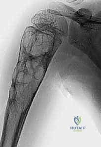 صورة طبية: أكياس العظام الحميدة: دليل شامل للتشخيص والعلاج الجراحي مع الأستاذ الدكتور محمد هطيف في صنعاء
