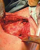 Illustration of benign bone cysts - Dr. Mohammed Hutaif