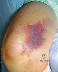 جراحة استبدال مفصل الكوع الكلي في اليمن