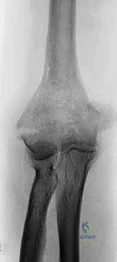 التشريح المعقد لمفصل الكوع والإصابات البالغة