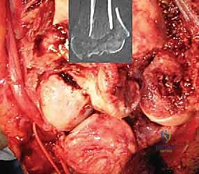 تركيب المفصل التجريبي لاختبار الحركة