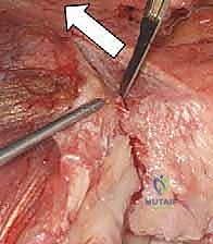 صورة شعاعية للمفصل بعد التثبيت