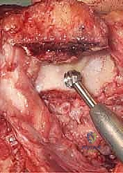 تأثير هشاشة العظام والكسور المفتتة