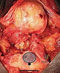 مقارنة الخيارات الجراحية وتحديد الأنسب للمريض