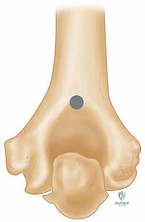 استبدال مفصل الكوع الكلي لكسور عظم العضد المفتتة: دليل شامل للمرضى مع الأستاذ الدكتور محمد هطيف
