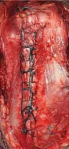 ربط جزئي المفصل الصناعي