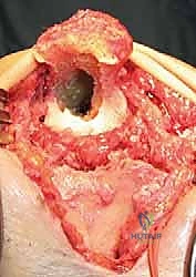 تفاصيل تثبيت المفصل المترابط