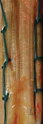 تثبيت جذع العضد بالإسمنت