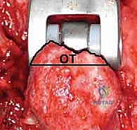 توزيع الإسمنت العظمي بشكل مثالي