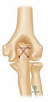 إغلاق الجرح بشكل تجميلي ودقيق