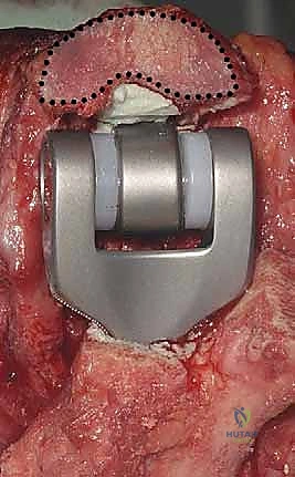 تقييم الثبات الجانبي للمفصل