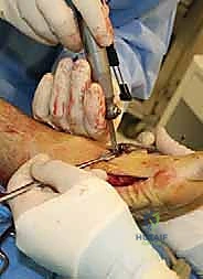Illustration of medial displacement calcaneal - Dr. Mohammed Hutaif