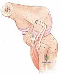 صورة توضيحية لـ إعادة بناء الزاوية الخلفية الوحشية للركبة: دليل شامل للمرضى مع الأستاذ الدكتور محمد هطيف