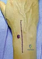 صورة توضيحية لـ عملية RASL: حل متقدم لعدم استقرار الرسغ الزورقي الهلالي مع الأستاذ الدكتور محمد هطيف