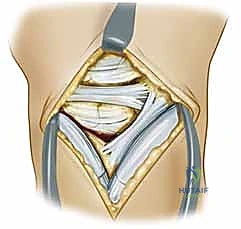 تنظيف المفصل وإزالة الأنسجة التالفة