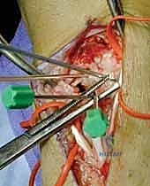 إدخال برغي الضغط