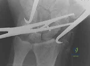 صورة توضيحية لـ عملية RASL: حل متقدم لعدم استقرار الرسغ الزورقي الهلالي مع الأستاذ الدكتور محمد هطيف