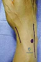 استخدام أسلاك K-wires لرد العظام