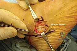 تأثير الوزن الزائد على مفاصل القدم