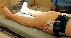 الأوتار والأربطة الداعمة لقوس القدم