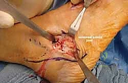 صورة توضيحية لـ إطالة العمود الجانبي للقدم: حل جراحي متقدم لتشوه القدم المسطحة المكتسبة مع الأستاذ الدكتور محمد هطيف