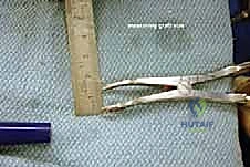 صورة طبية: إطالة العمود الجانبي للقدم: حل جراحي متقدم لتشوه القدم المسطحة المكتسبة مع الأستاذ الدكتور محمد هطيف