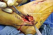 صورة توضيحية لـ إطالة العمود الجانبي للقدم: حل جراحي متقدم لتشوه القدم المسطحة المكتسبة مع الأستاذ الدكتور محمد هطيف