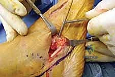 صورة طبية: إطالة العمود الجانبي للقدم: حل جراحي متقدم لتشوه القدم المسطحة المكتسبة مع الأستاذ الدكتور محمد هطيف