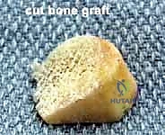 صورة طبية: إطالة العمود الجانبي للقدم: حل جراحي متقدم لتشوه القدم المسطحة المكتسبة مع الأستاذ الدكتور محمد هطيف