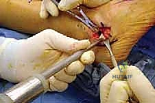 صورة طبية: إطالة العمود الجانبي للقدم: حل جراحي متقدم لتشوه القدم المسطحة المكتسبة مع الأستاذ الدكتور محمد هطيف