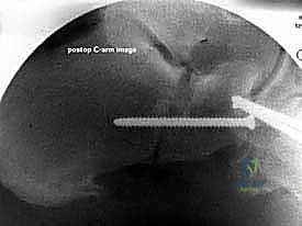 صورة طبية: إطالة العمود الجانبي للقدم: حل جراحي متقدم لتشوه القدم المسطحة المكتسبة مع الأستاذ الدكتور محمد هطيف