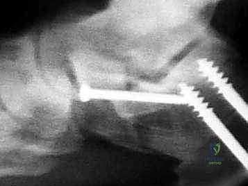 صورة طبية: إطالة العمود الجانبي للقدم: حل جراحي متقدم لتشوه القدم المسطحة المكتسبة مع الأستاذ الدكتور محمد هطيف