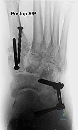 صورة طبية: إطالة العمود الجانبي للقدم: حل جراحي متقدم لتشوه القدم المسطحة المكتسبة مع الأستاذ الدكتور محمد هطيف