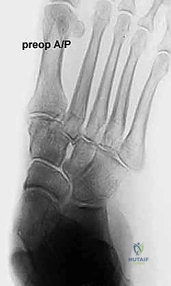 صورة طبية: إطالة العمود الجانبي للقدم: حل جراحي متقدم لتشوه القدم المسطحة المكتسبة مع الأستاذ الدكتور محمد هطيف