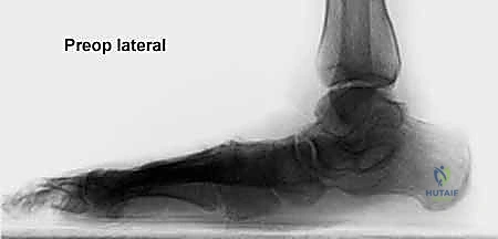 صورة طبية: إطالة العمود الجانبي للقدم: حل جراحي متقدم لتشوه القدم المسطحة المكتسبة مع الأستاذ الدكتور محمد هطيف